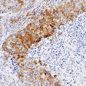 Ephrin-A4 antibody in Human Squamous Cell Carcinoma by Immunohistochemistry (IHC-P).
