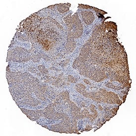 Ephrin-A4 antibody in Human Squamous Cell Carcinoma by Immunohistochemistry (IHC-P).