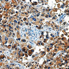 Ephrin-A5 antibody in Human Melanoma by Immunohistochemistry (IHC-P).