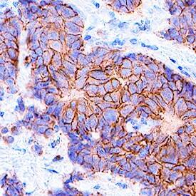 ErbB2/Her2 antibody in Human Breast Cancer Tissue by Immunohistochemistry (IHC-P).