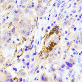 ErbB2/Her2 antibody in Human Breast Cancer Tissue by Immunohistochemistry (IHC-P).