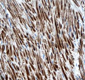 ErbB4/Her4 antibody in Human Colon Cancer Tissue by Immunohistochemistry (IHC-P).