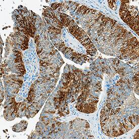FABP4/A-FABP antibody in Human Bladder Cancer Tissue by Immunohistochemistry (IHC-P).