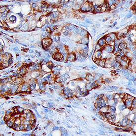 FBPase 1 antibody in Human Liver Cancer Tissue by Immunohistochemistry (IHC-P).