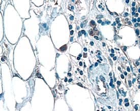 FGF-3 antibody in Human Breast Cancer Tissue by Immunohistochemistry (IHC-P).