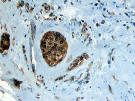 FGF-4 antibody in Human Breast Cancer Tissue by Immunohistochemistry (IHC-P).
