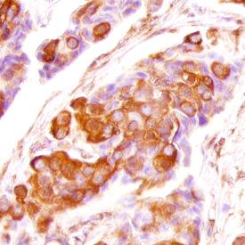 FGF-5 antibody in Human Breast Cancer Tissue by Immunohistochemistry (IHC-P).