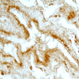FGF-5 antibody in Human Breast Cancer Tissue by Immunohistochemistry (IHC-P).