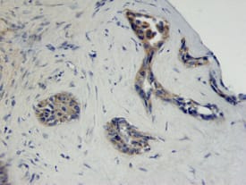 FGF R2 antibody in Human Adenocarcinoma by Immunohistochemistry (IHC-P).