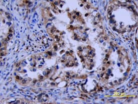 FGF basic/FGF2/bFGF antibody in Human Ovarian Cancer Tissue by Immunohistochemistry (IHC-P).