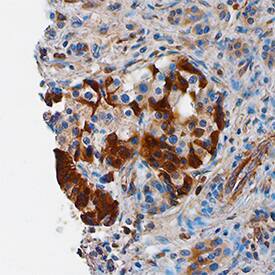 FLIP antibody in Human Pancreatic Cancer Tissue by Immunohistochemistry (IHC-P).