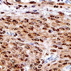 FOXL2 antibody in Ovarian Cancer Tissue by Immunohistochemistry (IHC-P).