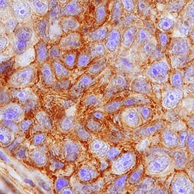 FPRP/PTGFRN antibody in Human Lung Cancer Tissue by Immunohistochemistry (IHC-P).