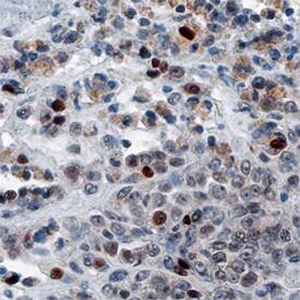 FRA-1 antibody in Human Melanoma by Immunohistochemistry (IHC-P).