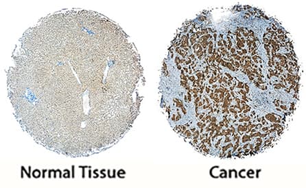 FRS2 antibody in Human Liver and Liver Cancer Tissue by Immunohistochemistry (IHC-P).