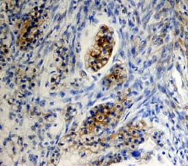 FSH R antibody in Human Ovarian Cancer Tissue by Immunohistochemistry (IHC-P).