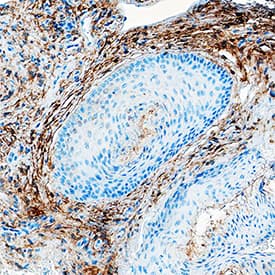 Fibroblast Activation Protein a/FAP antibody in Human Basal Cell Carcinoma by Immunohistochemistry (IHC-P).