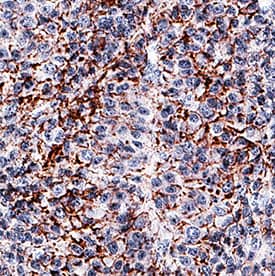 Fibronectin antibody in Human Liver Cancer Tissue by Immunohistochemistry (IHC-P).