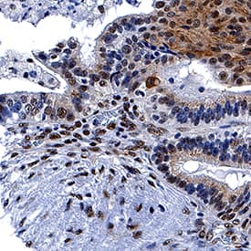 FoxP3 antibody in Human Ovarian Cancer Tissue by Immunohistochemistry (IHC-P).