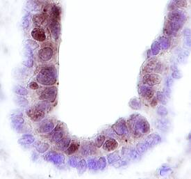 Frk antibody in Human Breast Cancer Tissue by Immunohistochemistry (IHC-P).