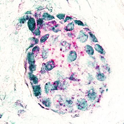 GATA-3 antibody in Human Breast Cancer Tissue Using Dual RNAscope® ISH and IHC.
