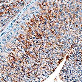 Glucosaminyl (N-acetyl) Transferase 1/GCNT1 antibody in Human Bladder Cancer Tissue by Immunohistochemistry (IHC-P).