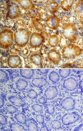 GDF-11/BMP-11 antibody in Human Colon Cancer Tissue by Immunohistochemistry (IHC-P).