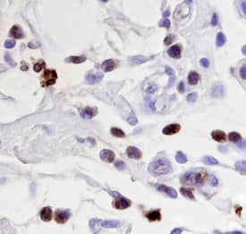 GRB2 antibody in Human Breast Cancer Tissue by Immunohistochemistry (IHC-P).