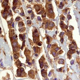 GRB2 antibody in Human Breast Cancer Tissue by Immunohistochemistry (IHC-P).