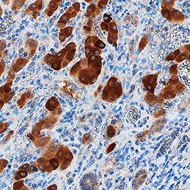 GRB7 antibody in Human Liver Cancer Tissue by Immunohistochemistry (IHC-P).