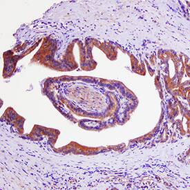 GRK3 antibody in Human Prostate Cancer Tissue by Immunohistochemistry (IHC-P).