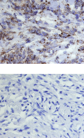 GRP75/HSPA9B antibody in Human Meningioma by Immunohistochemistry (IHC-P).