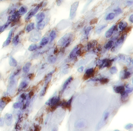 GRP75/HSPA9B antibody in Human Fibroblast Menangioma by Immunohistochemistry (IHC-P).
