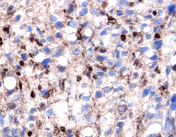 Galectin-1 antibody in Human Prostate Cancer Tissue by Immunohistochemistry (IHC-P).