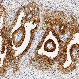 Galectin-3 antibody in Human Prostate Cancer Tissue by Immunohistochemistry (IHC-P).