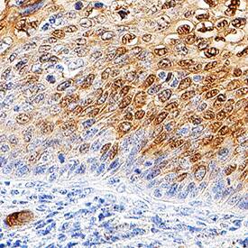 Galectin-7 antibody in Human Cervical Cancer Tissue by Immunohistochemistry (IHC-P).