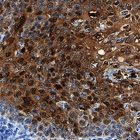 Galectin-7 antibody in Human Cervical Cancer Tissue by Immunohistochemistry (IHC-P).