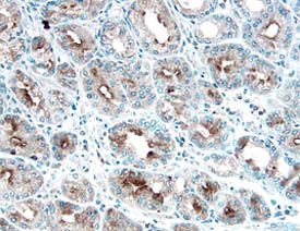 Gas6 antibody in Human Stomach Cancer Tissue by Immunohistochemistry (IHC-P).