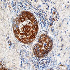 Glutaredoxin 3/GLRX3 antibody in Human Breast Cancer Tissue by Immunohistochemistry (IHC-P).