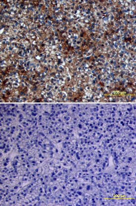 Glypican 3 antibody in Human Liver Cancer Tissue by Immunohistochemistry (IHC-P).