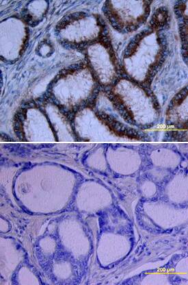 Growth Hormone R/GHR antibody in Human Breast Cancer Tissue by Immunohistochemistry (IHC-P).