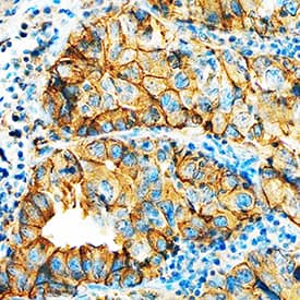 HAI-1 antibody in Human Lung Cancer Tissue by Immunohistochemistry (IHC-P).