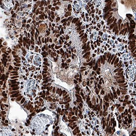 Host Cell Factor 1/HCFC1 antibody in Human Colon Cancer Tissue by Immunohistochemistry (IHC-P).