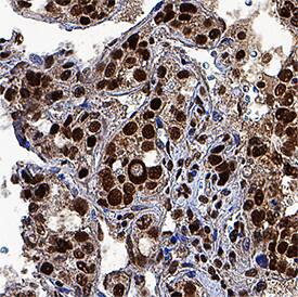 HES-1 antibody in Human Liver Cancer Tissue by Immunohistochemistry (IHC-P).