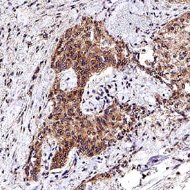 HGF antibody in Human Lung Adenocarcinoma Tissue by Immunohistochemistry (IHC-P).