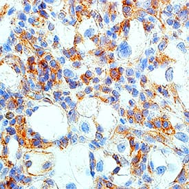 HGF R/c-MET antibody in Human Renal Cell Carcinoma Tissue by Immunohistochemistry (IHC-P).