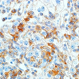 HGF R/c-MET antibody in Human Renal Cell Carcinoma Tissue by Immunohistochemistry (IHC-P).