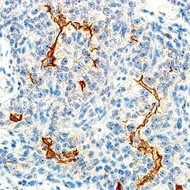 HGF R/c-MET antibody in Human Renal Cell Carcinoma Tissue by Immunohistochemistry (IHC-P).
