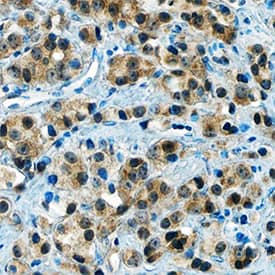 HIF-2a/EPAS1 antibody in Human Prostate Cancer Tissue by Immunohistochemistry (IHC-P).