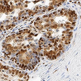 HMGB1/HMG-1 antibody in Human Prostate Cancer Tissue by Immunohistochemistry (IHC-P).